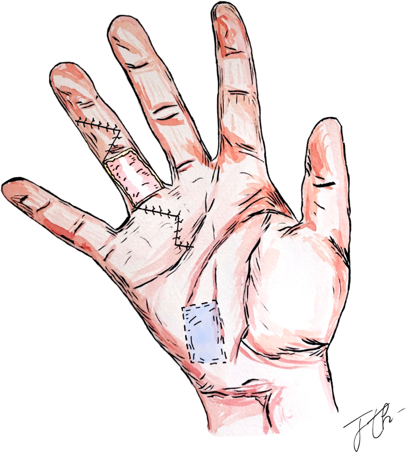 La maladie de Dupuytren-04