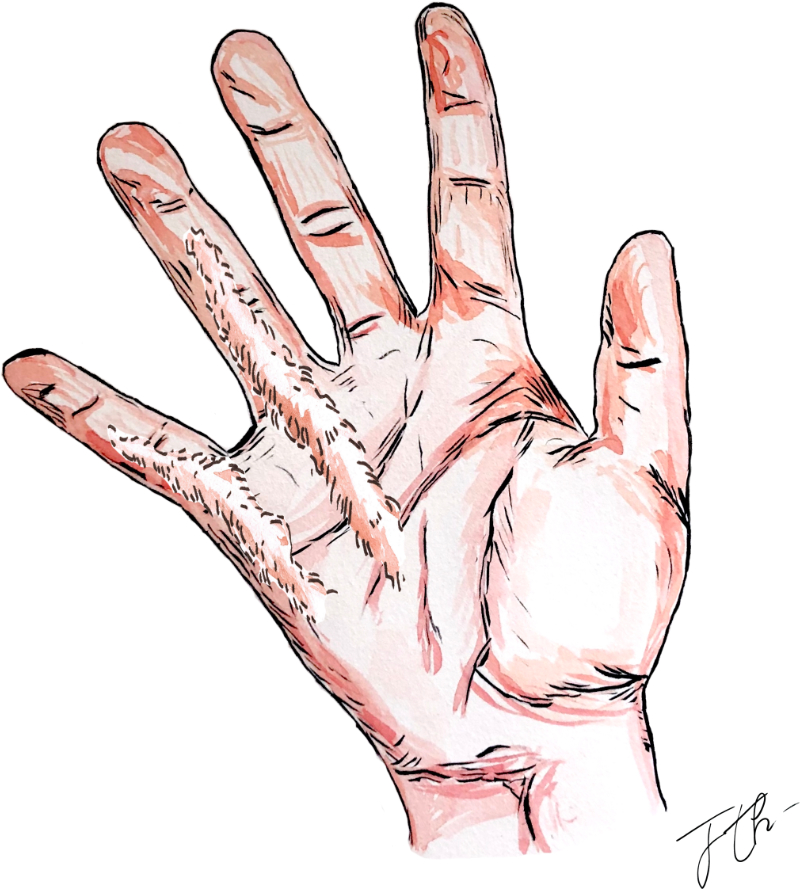 La maladie de Dupuytren-04