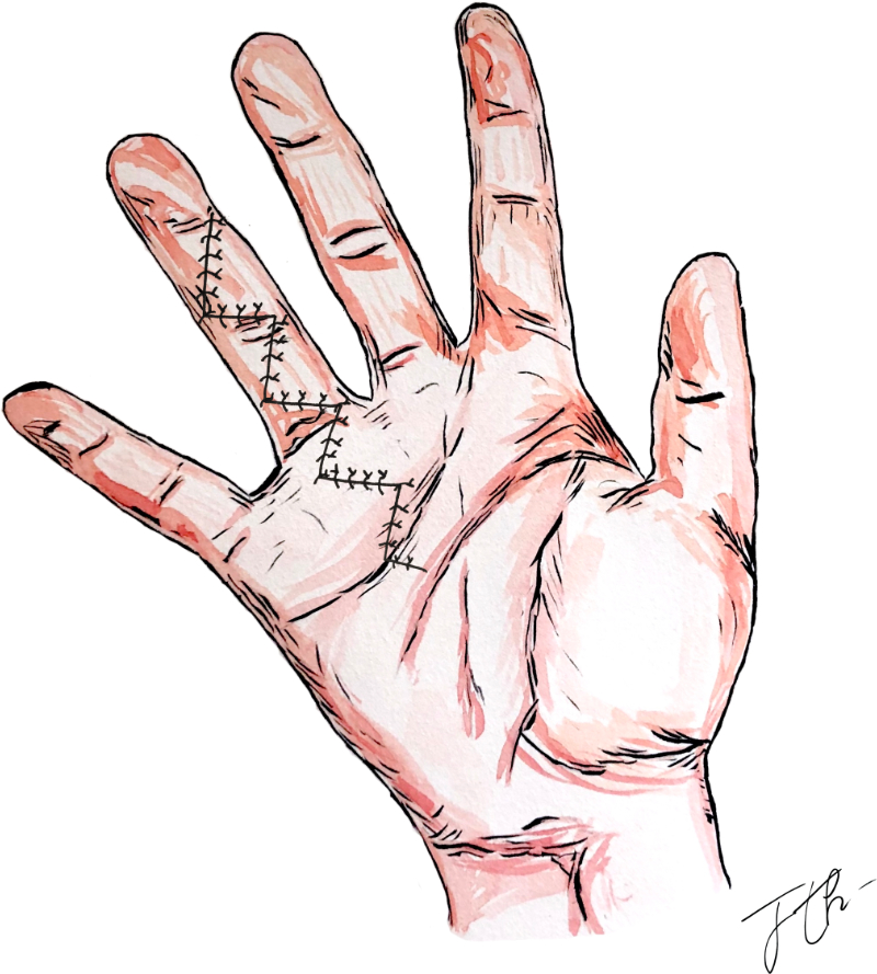 La maladie de Dupuytren-04