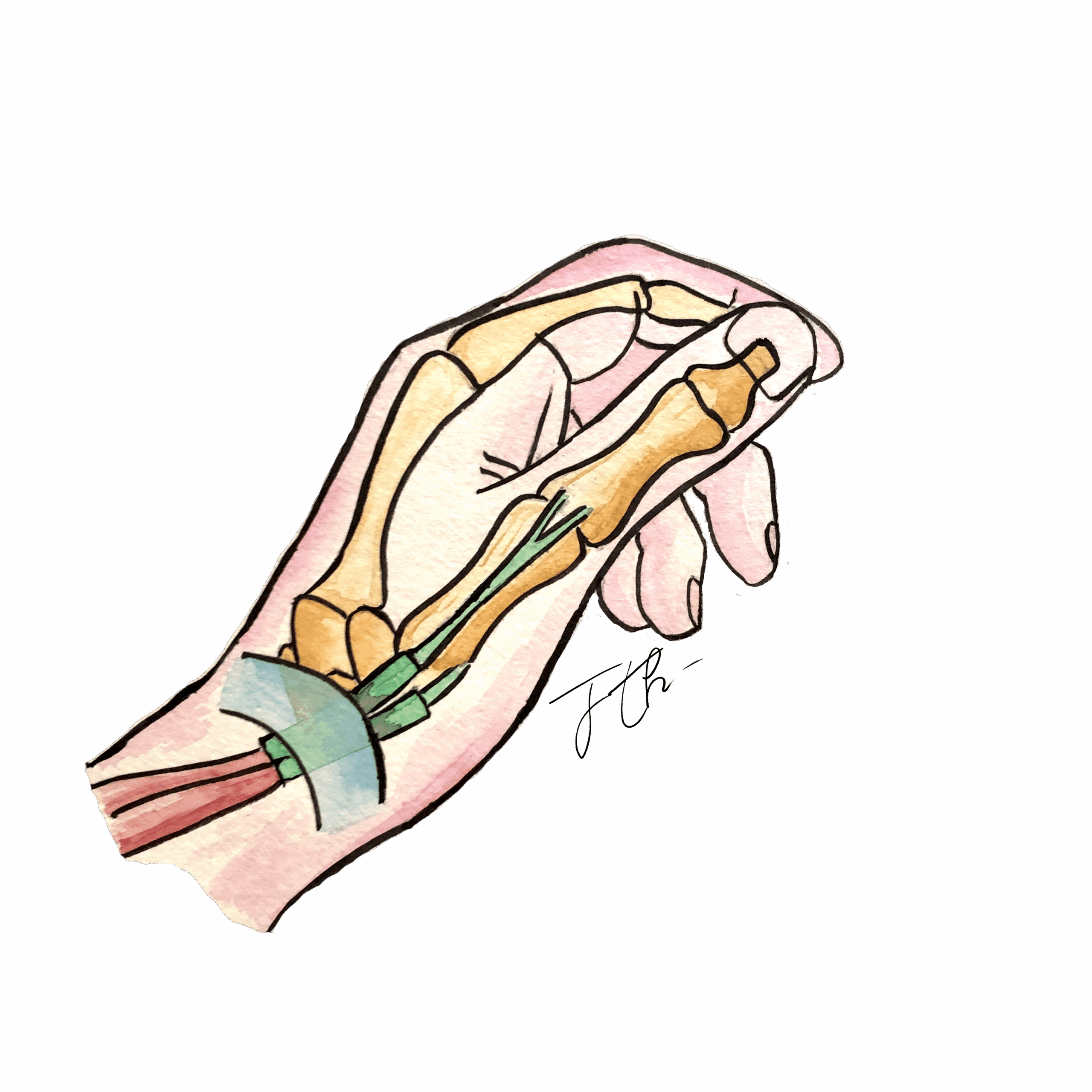 tendinite de quervain