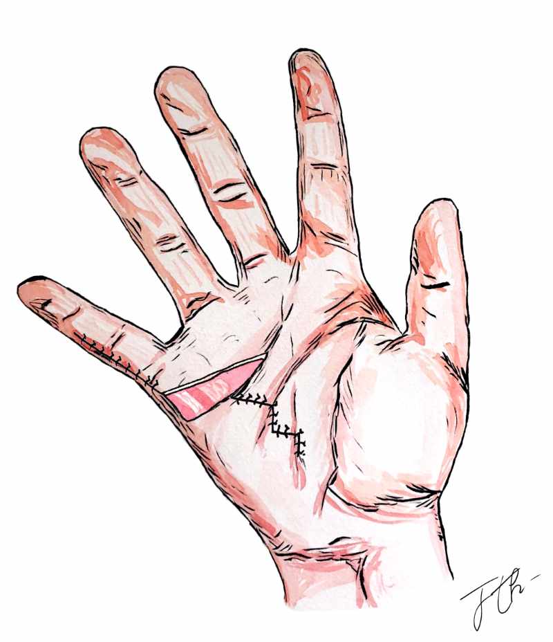 La maladie de Dupuytren-