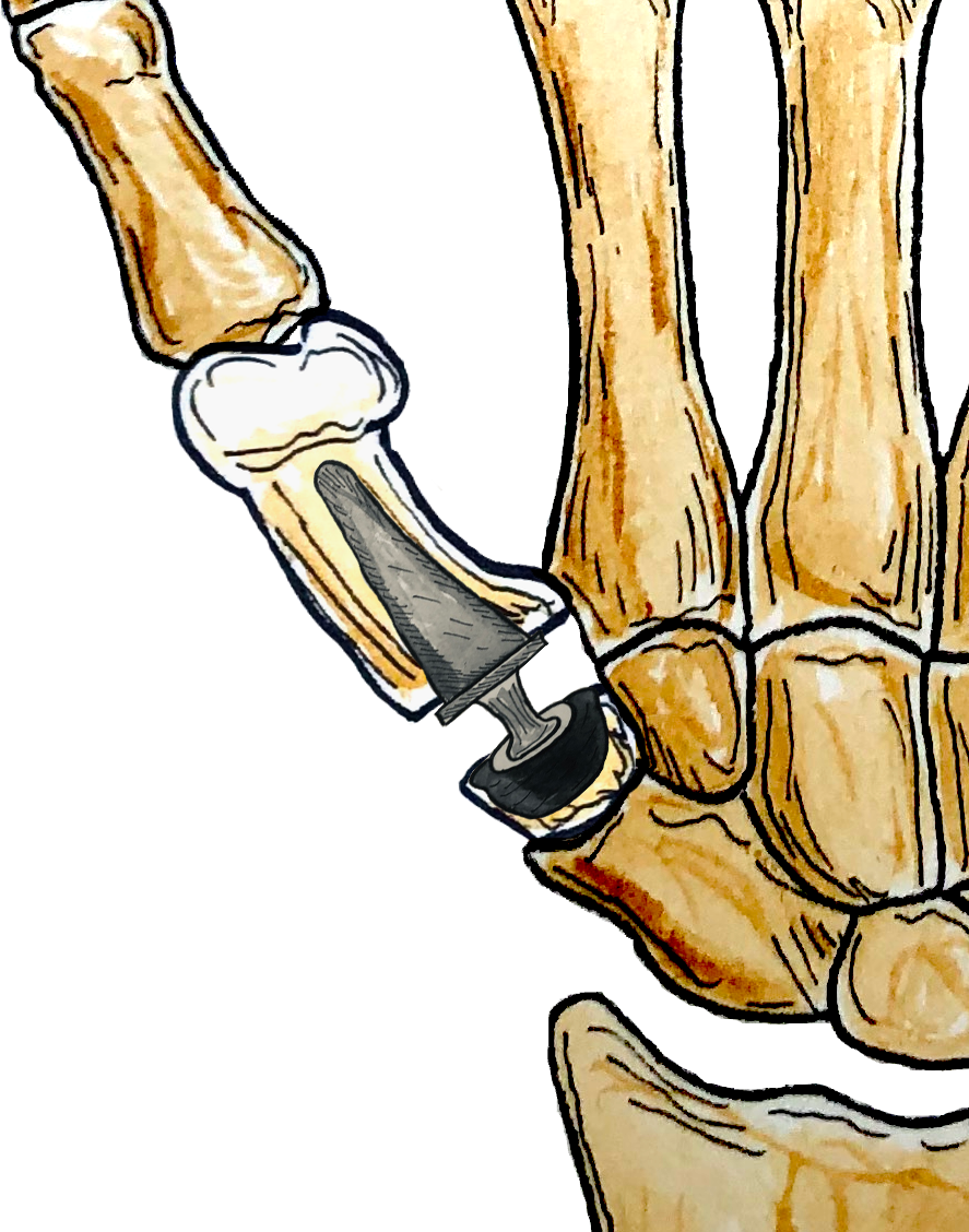 trapzeo metacarpienne